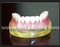 Dental Shape of Implant Teeth Teaching Model