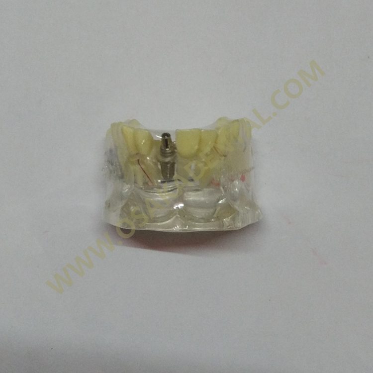 OSA-2008A Dental Implant Models with Caries Teeth Model