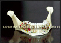 Dental shape of Teeth implant Teaching Model