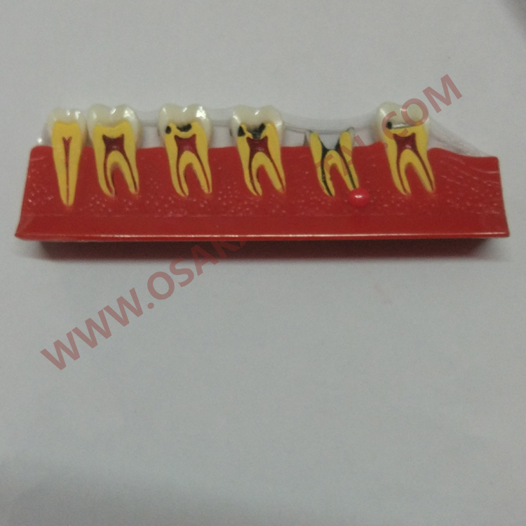 OSA-4011A Caries Teeth Shape of dental teaching model / dental model / dental handpiece / dental equipment