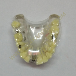 OSA-2008A Dental Implant Models with Caries Teeth Model