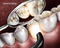 dental supply Dental Led Curing Light TPC LED70