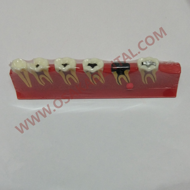 OSA-4011A Caries Teeth Shape of dental teaching model / dental model / dental handpiece / dental equipment