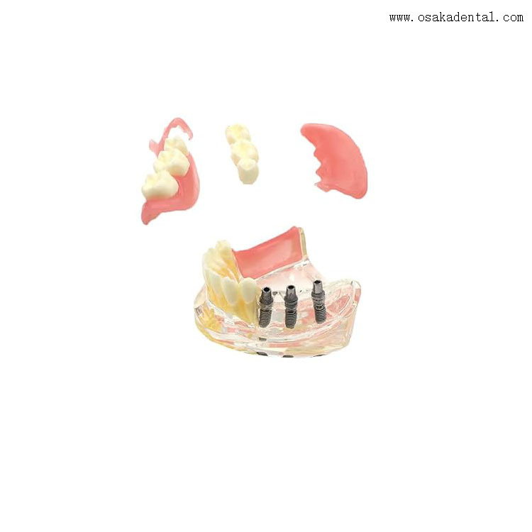 Dental Implant Restoration Comparison Model for Dentist Teaching