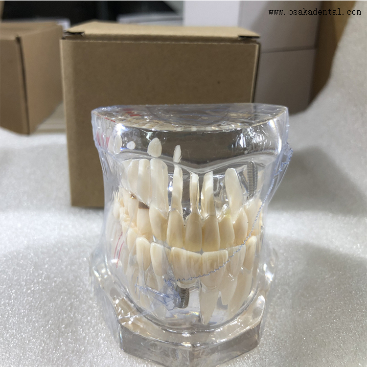 Dental Pathological Teeth Implant Model for Practicing