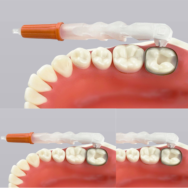 New Disposable Dental Wingless Retainer and Matrix