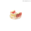 Dental Implant Restoration Comparison Model for Dentist Teaching