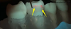 New Model Dental Handpiece with Caries Detecting Caries Detection Handpiece with Generator Handpiece with Lighting