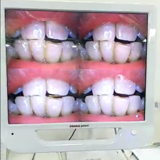 17inch Dental Intraoral Camera with Monitor and metal Holder.