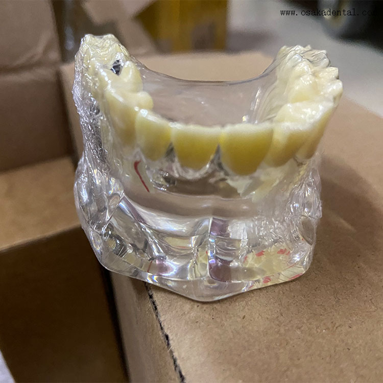 Dental Implant Restoration Comparison Model for Dentist Teaching