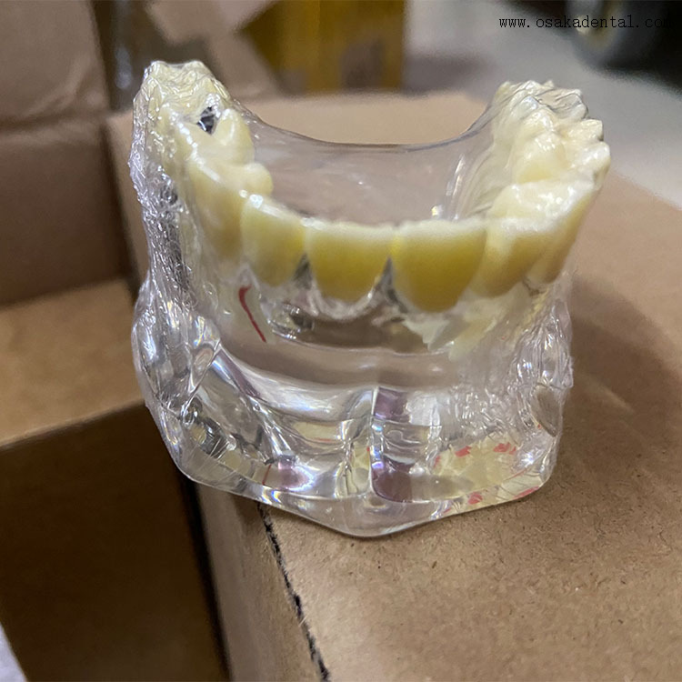 Dental Implant Restoration Comparison Model for Dentist Teaching