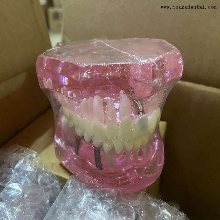 Dental Teeth Implant Model for Dentist Teaching