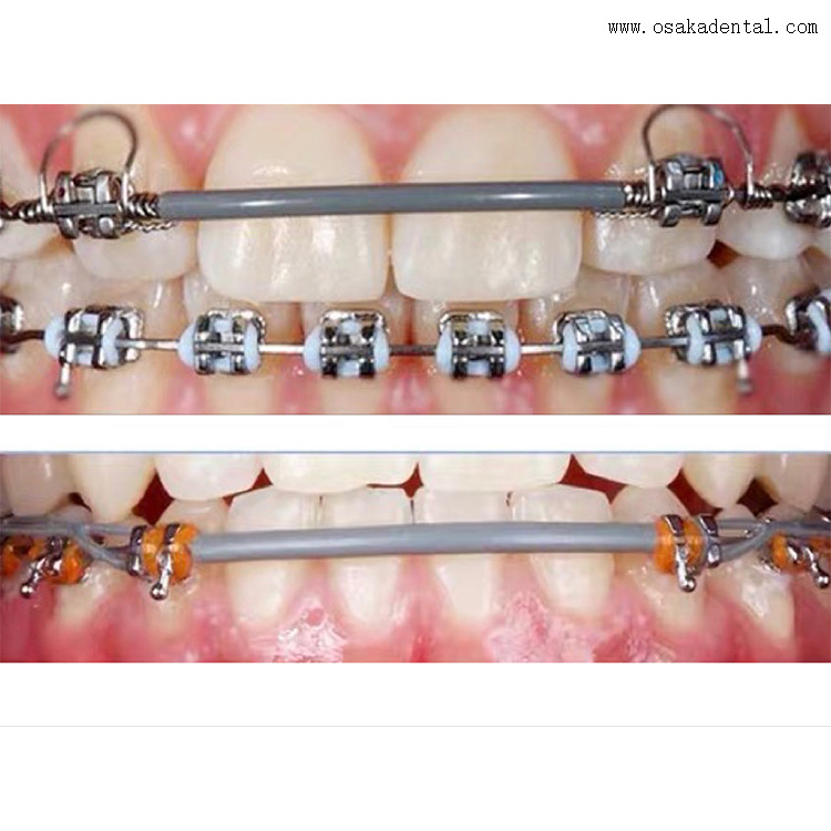 Dental Orthodontic Archwire Sleeve