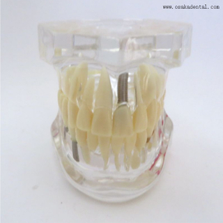 Dental Pathological Teeth Implant Model for Practicing