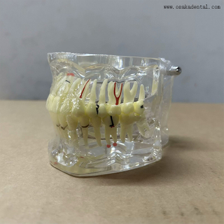 Dental Teeth Pathology Model for Dentist Teaching