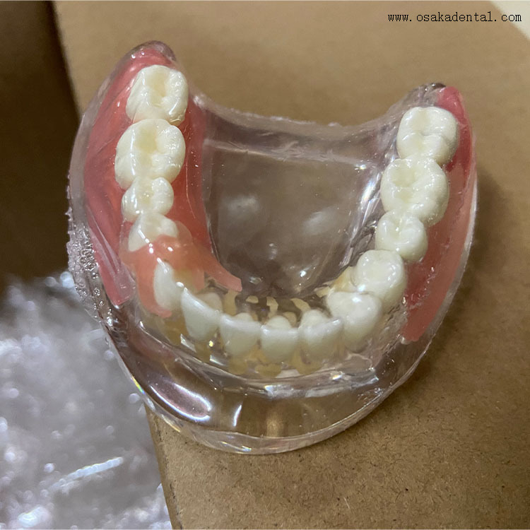 Dental Implant Restoration Comparison Model for Dentist Teaching