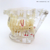 Dental Pathological Teeth Implant Model for Practicing