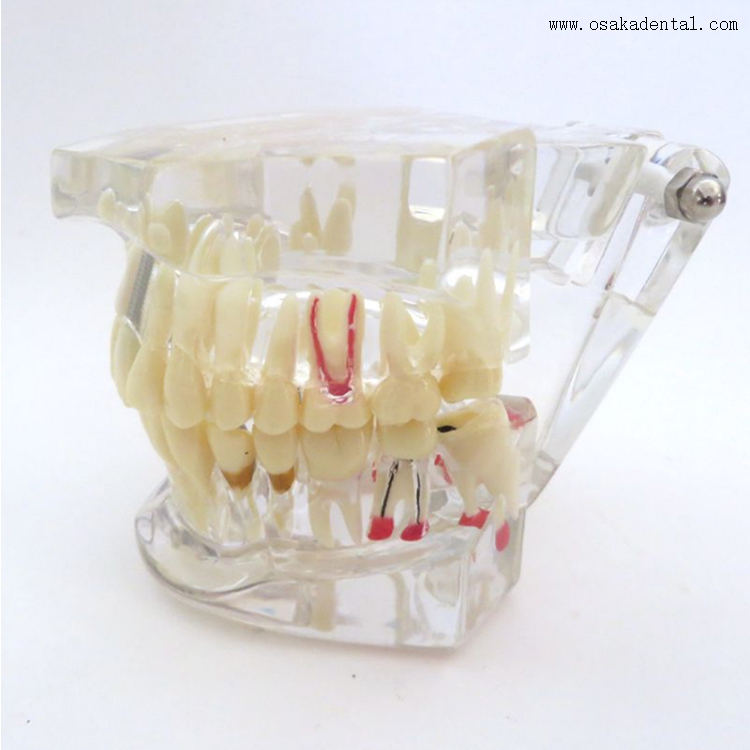 Dental Pathological Teeth Implant Model for Practicing