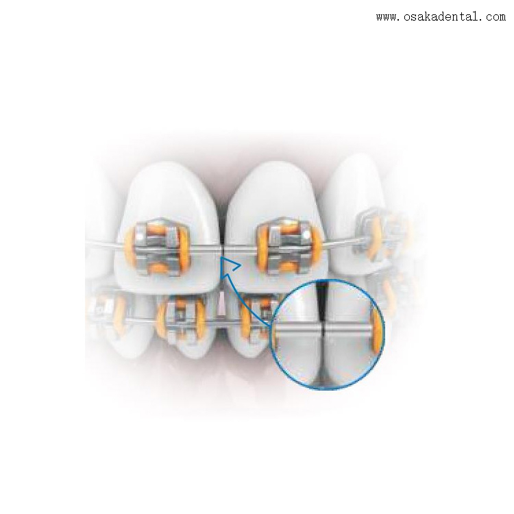 Dental Orthodontic Accessories Mini Stop for Arches