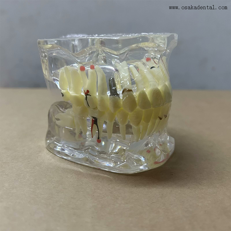 Dental Teeth Pathology Model for Dentist Teaching
