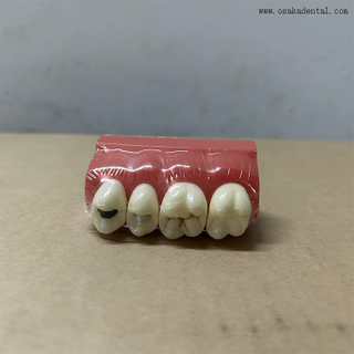 Dental Pit And Fissure Sealant Demonstration Model 