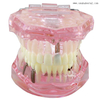 Dental Teeth Implant Model for Dentist Teaching