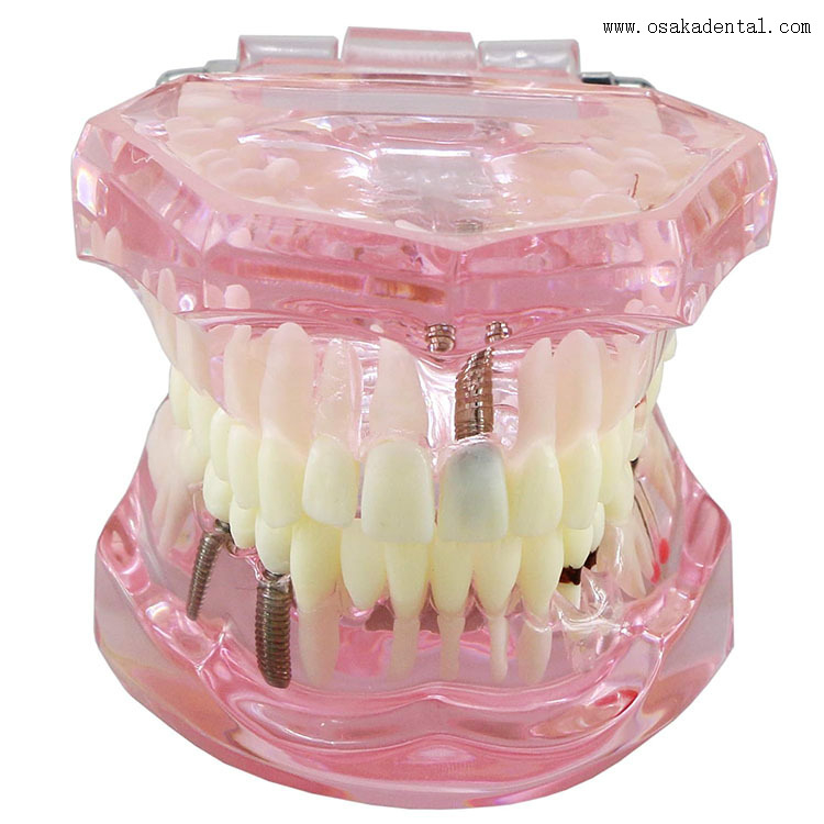 Dental Teeth Implant Model for Dentist Teaching