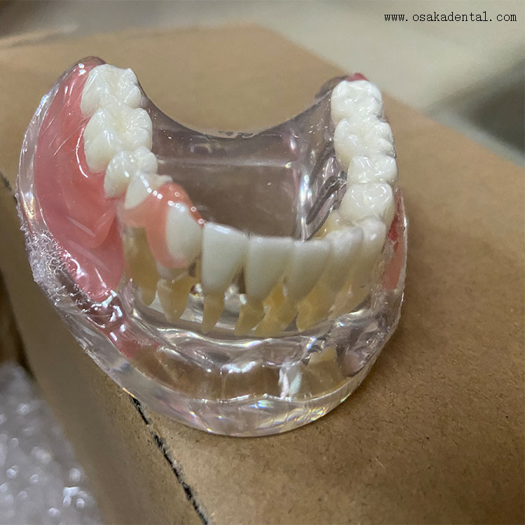 Dental Implant Restoration Comparison Model for Dentist Teaching