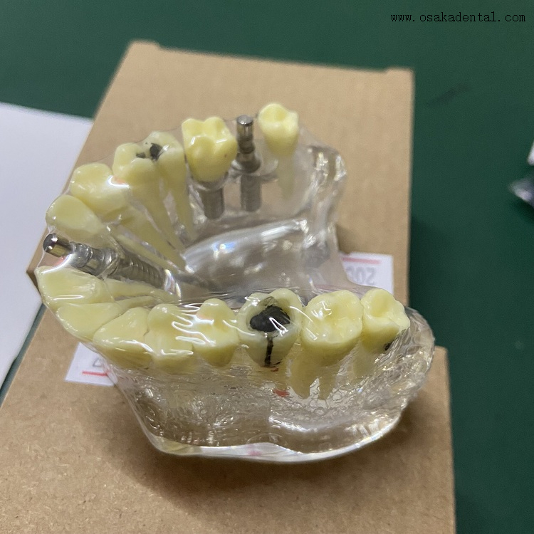 Denta Implant Models with Caries OSA-2008A