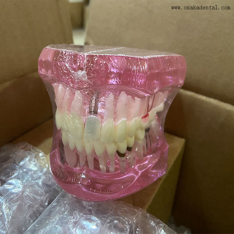 Dental Teeth Implant Model for Dentist Teaching