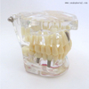 Dental Pathological Teeth Implant Model for Practicing