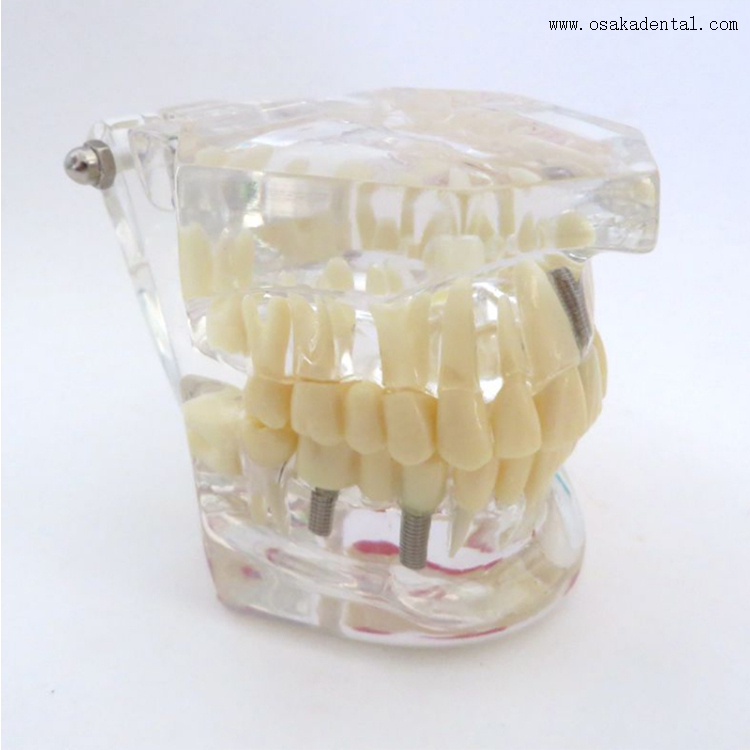 Dental Pathological Teeth Implant Model for Practicing