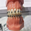 Dental Self-ligating Metal Bracket for Dental Orthodontic