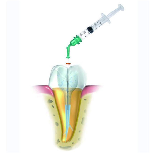 Dental Negative Pressure Endo Irrigation System