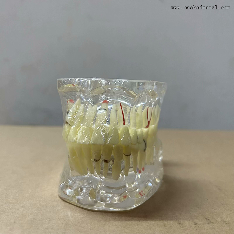 Dental Teeth Pathology Model for Dentist Teaching