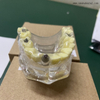 Denta Implant Models with Caries OSA-2008A