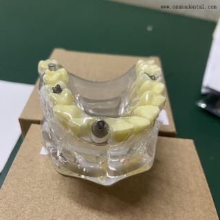 Denta Implant Models with Caries OSA-2008A