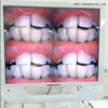 17inch Dental Intraoral Camera with Monitor and metal Holder