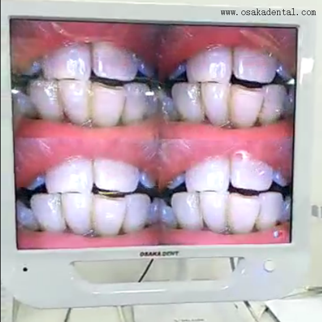 17inch Dental Intraoral Camera with Monitor and metal Holder