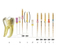 Niti Protaper Golden Heat Activation Dental File